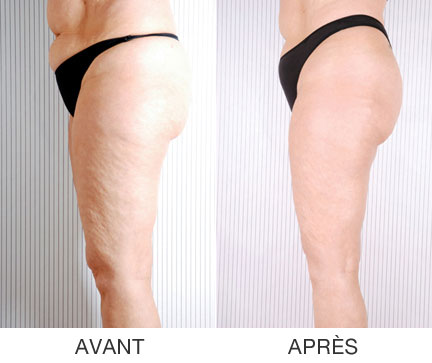 Lumicell Cellulite and Body Contouring, Toronto