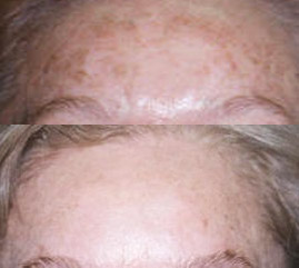 hyperpigmentation treatment avora skin spa coquitlam