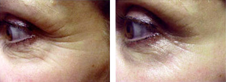eye zone treatment therapy at Avora Skin Spa, Coquitlam