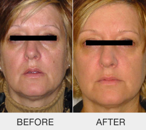 kinelift-non-surgical-face-lifting_03