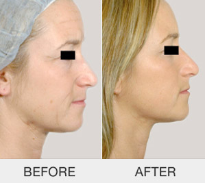 kinelift-non-surgical-face-lifting_04