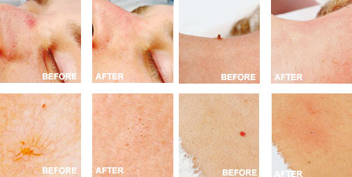 vasculyse-2g-skin-tags-spider-veins-removal_02