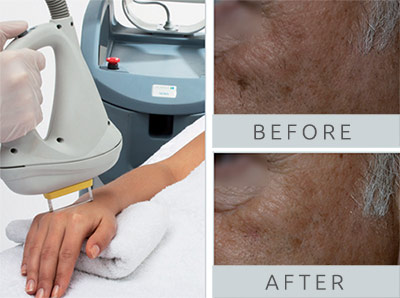 laser-hair-removal-1